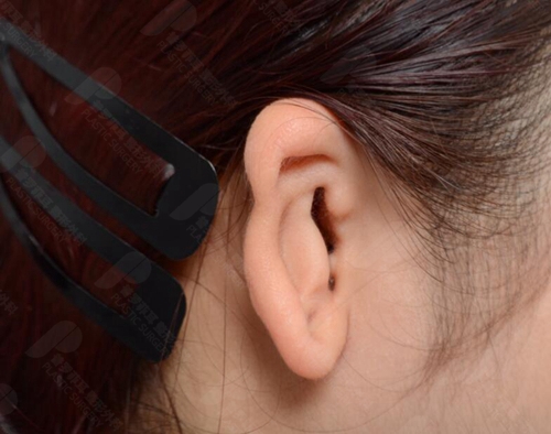 耳再造手术半包法和全包法有什么区别？