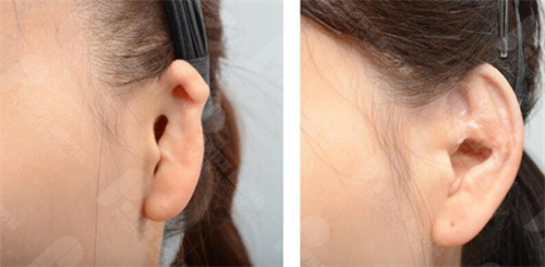 扩张皮瓣法外耳再造和直埋法耳再造有啥区别