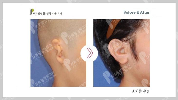 耳再造手术案例