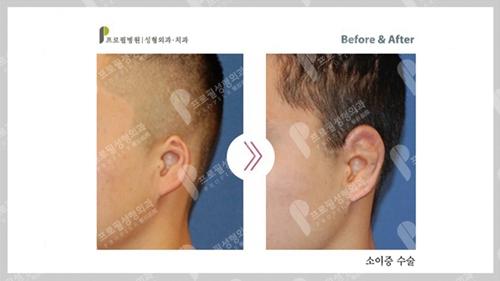 耳再造手术案例