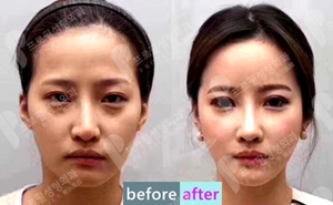 普罗菲耳profile面部脂肪填充真人案例