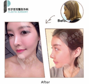 普罗菲耳profile眼鼻综合真人案例