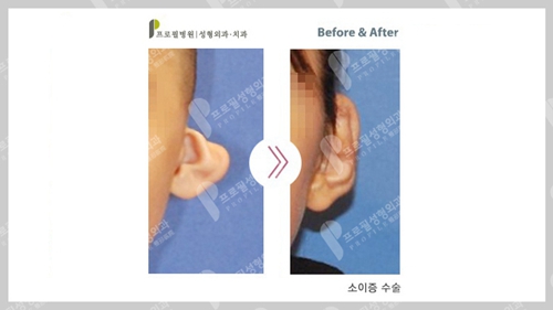 韩国profile整形外科郑在皓小耳畸形矫正案例