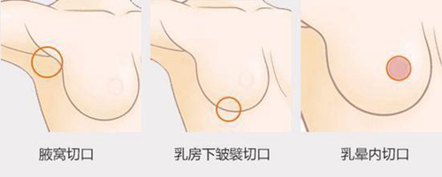 三种隆胸切口方式