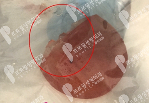 韩国profile普罗菲耳医院假体隆胸修复