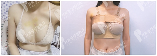 韩国profile普罗菲耳医院隆胸修复案例
