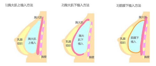 韩国profile普罗菲耳医院假体植入位置