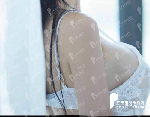 韩国profile普罗菲耳整形医院假体隆胸术后第四十天