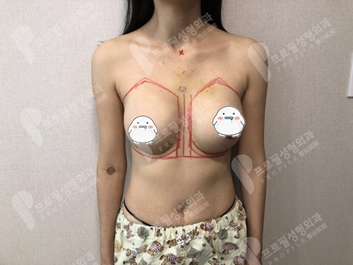 韩国profile普罗菲耳整形医院假体隆胸修复术前划线