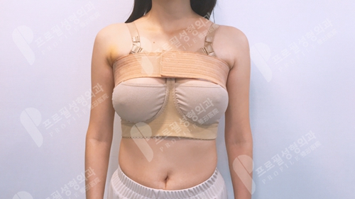 韩国profile普罗菲耳整形医院魔滴假体隆胸术后第一天