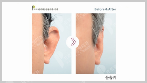 	 韩国profile普罗菲耳整形医院成人招风耳矫正手术案例