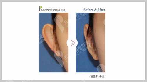 	 韩国profile普罗菲耳整形医院招风耳改善真实案例