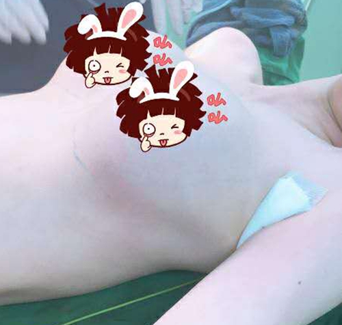 韩国profile普罗菲耳医院假体隆胸术后即刻