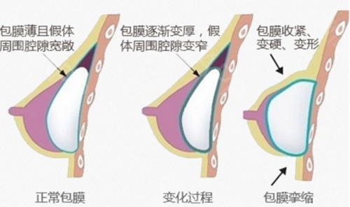 韩国profile普罗菲耳医院隆胸包膜形成