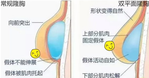 韩国profile普罗菲耳医院双平面隆胸