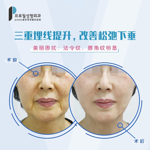 韩国profile普罗菲耳整形医院三重埋线提升案例