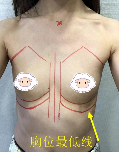 隆胸假体下滑，位移是怎么回事？profile普罗菲耳郑在皓院长是如何解决这些隆胸后遗症的？