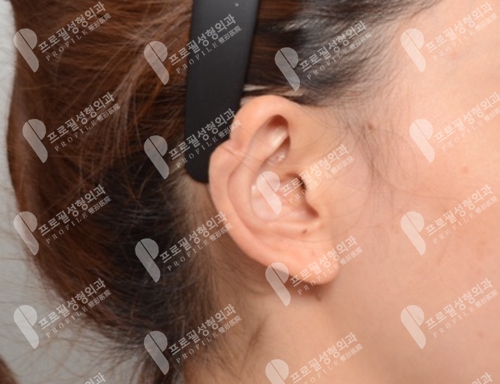 韩国profile普罗菲耳整形医院耳轮修复前