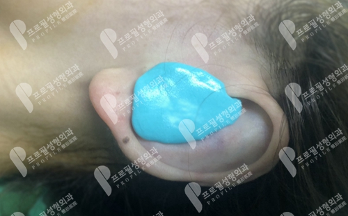 韩国profile普罗菲耳整形医院耳轮凹陷修复手术