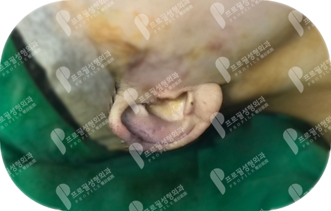 韩国profile普罗菲耳整形医院耳轮凹陷修复手术案例