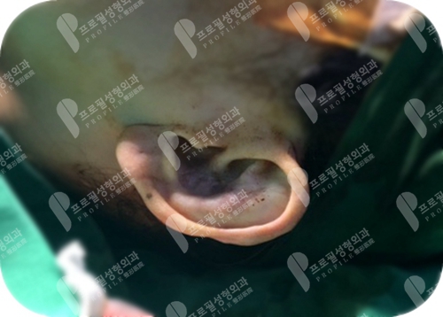 韩国profile普罗菲耳整形医院如何正确取耳软骨