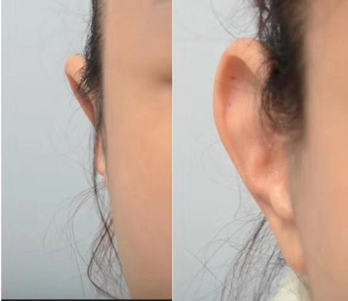 韩国profile普罗菲耳整形医院贴发耳矫正案例
