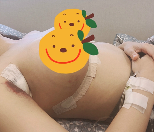 韩国profile普罗菲耳整形医院假体隆胸术后