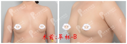 韩国profile普罗菲耳医院曼托新款X-tra光面假体案例术前