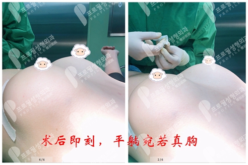 韩国profile普罗菲耳医院曼托新款X-tra光面假体案例术后即刻