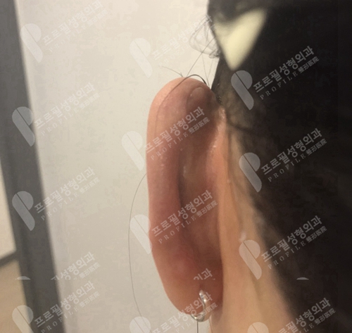 韩国profile普罗菲耳整形医院耳整形手术疤痕示意图