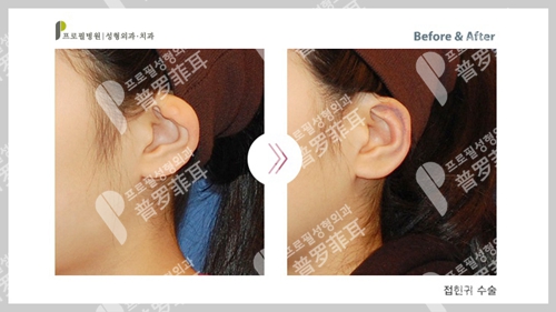 韩国profile普罗菲耳整形医院杯状耳矫正案例