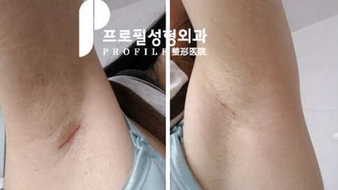 普罗菲耳隆胸术后疤痕照片