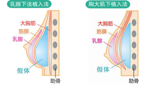 常见的隆胸植入方式