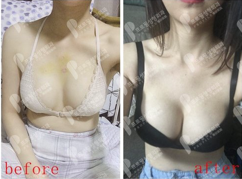 普罗菲耳隆胸手术对比
