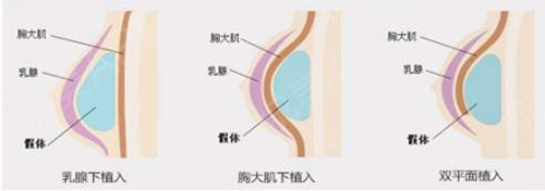 假体隆胸植入方法示意图