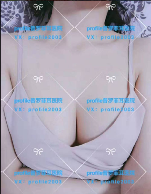 普罗菲耳医院隆胸效果图