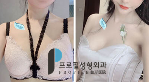 韩国Profile隆胸手术多少钱