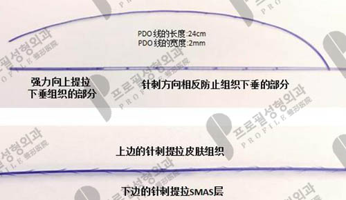 韩国profile普罗菲耳提升手术优势