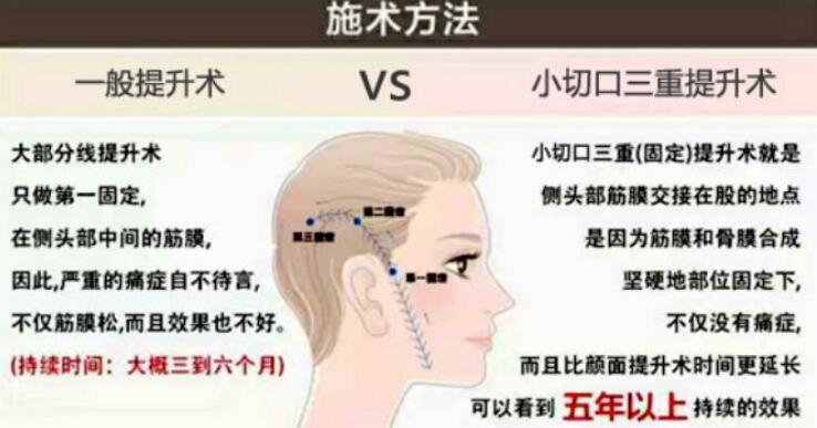 韩国profile普罗菲耳提升手术