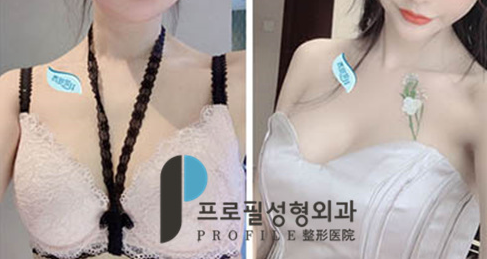 韩国普罗菲耳整形外科隆胸手术效果好吗