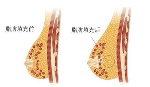 自体脂肪隆胸术前术后对比