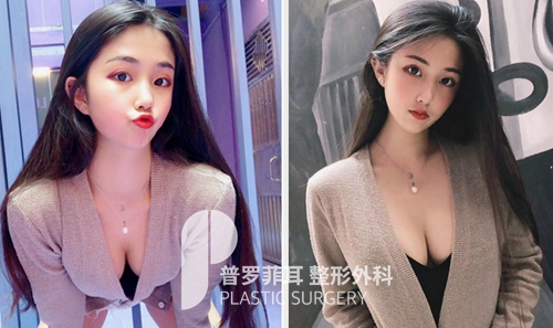 找郑在皓院长做猫系少女胸术后两年的效果