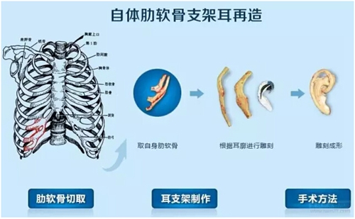 采用自体肋软骨做人工支架的过程