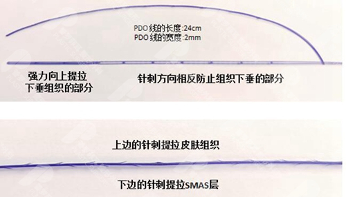 小切口三重提升术使用的线材