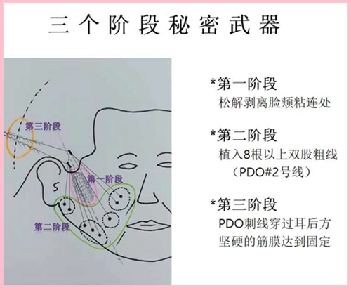 普罗菲耳朴明旭小切口手术提升固定位置