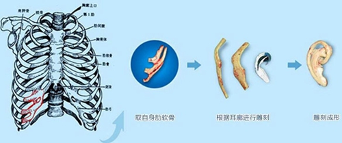 自体肋软骨耳再造手术过程示意图