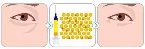 自体脂肪填充去泪沟