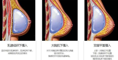 郑在皓院长在做假体隆胸时一般采用的是双平面技术