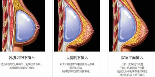 隆胸假体植入层次太浅导致有褶皱感