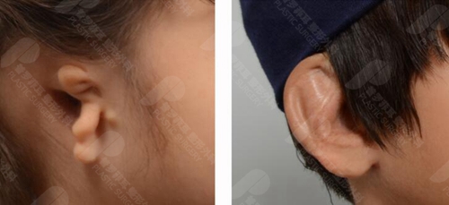 详细分析用自体肋软骨和人工支架做耳再造手术的差异